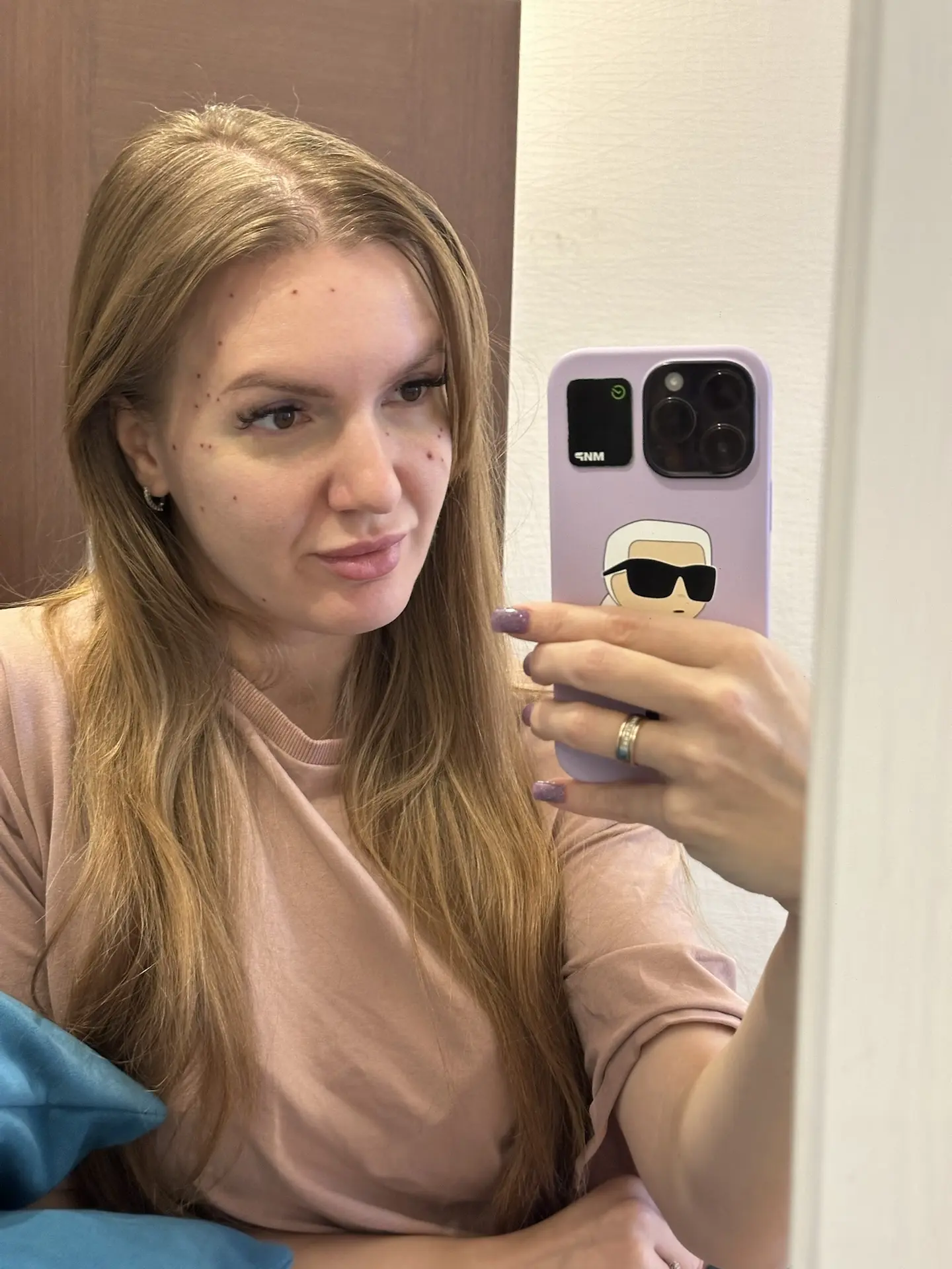Гиперплазия сальных желез

Делала эту процедуру ещё в январе 2025г. 
Но спустя 1,5 года появились сн