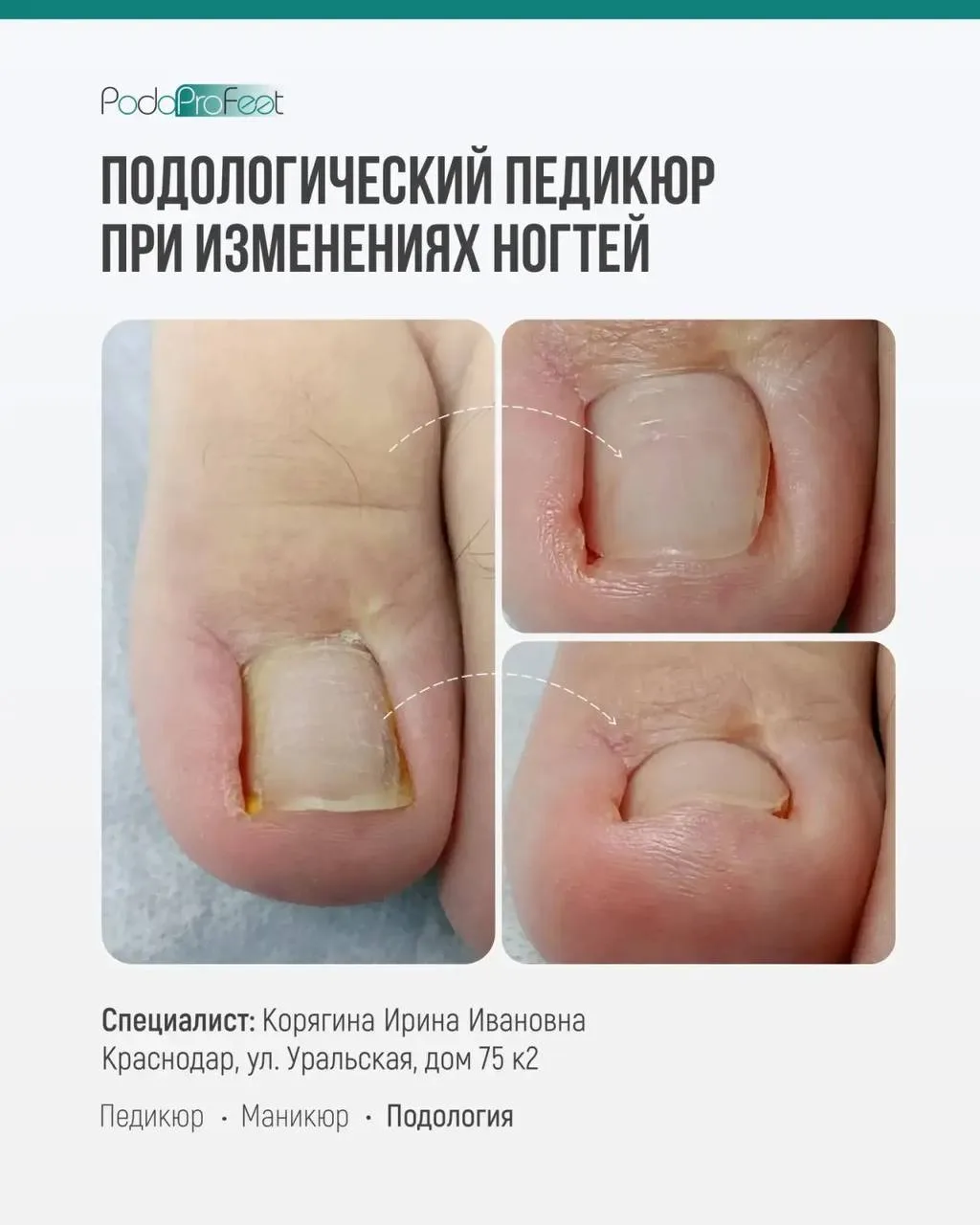 Когда проблема не заканчивается после процедуры

Многие специалисты знают, как убрать вросший сегмен