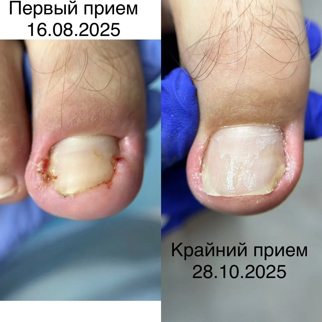 Не исключение а правило ✅С 2021 года по сегодняшний день я совершенствовала протокол работы с вросши