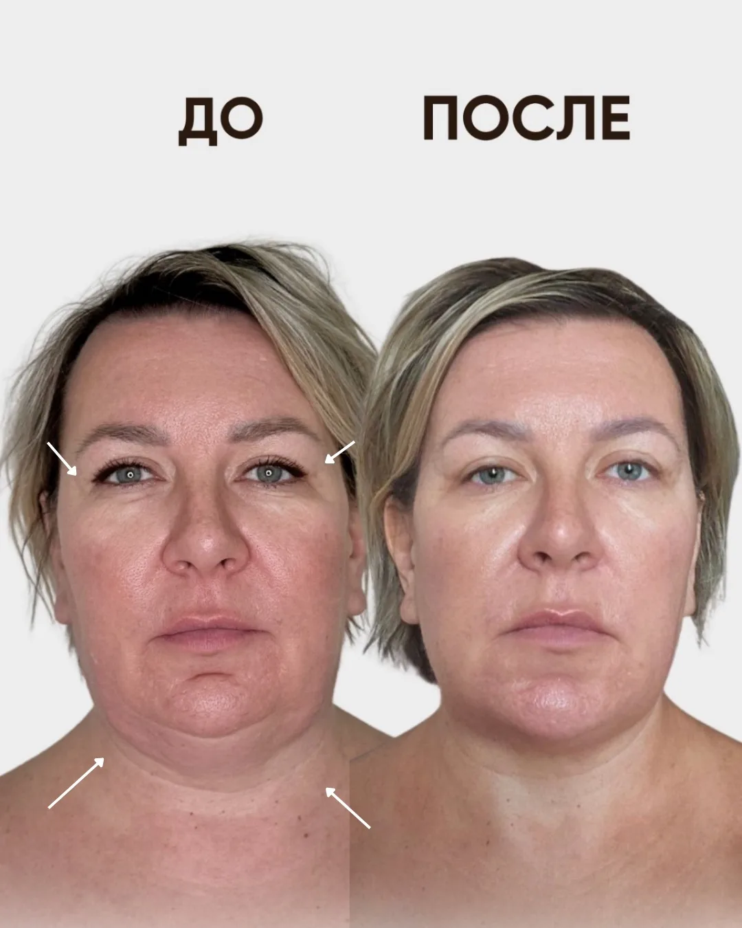 Вот так выглядит результат после Эндолифта через пол года!

Основной эффект раскрывается постепенно,