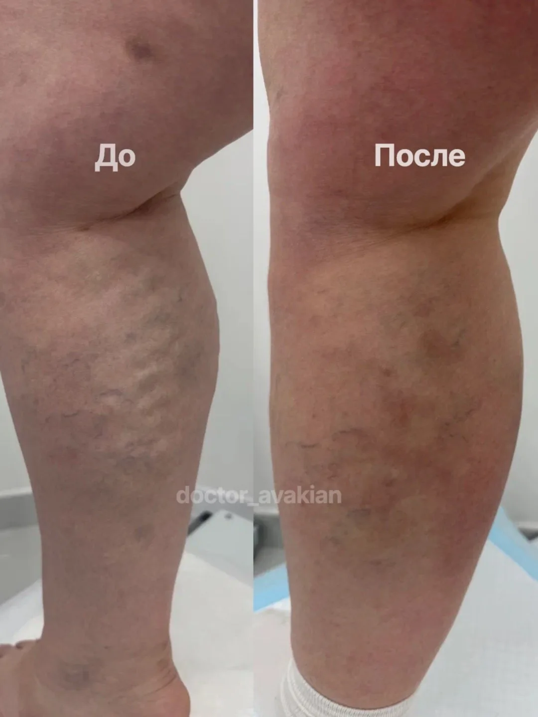 А вот и результаты «до и после» моих пациентов 🔥

Каждый раз я рад видеть, как человек наконец-то р
