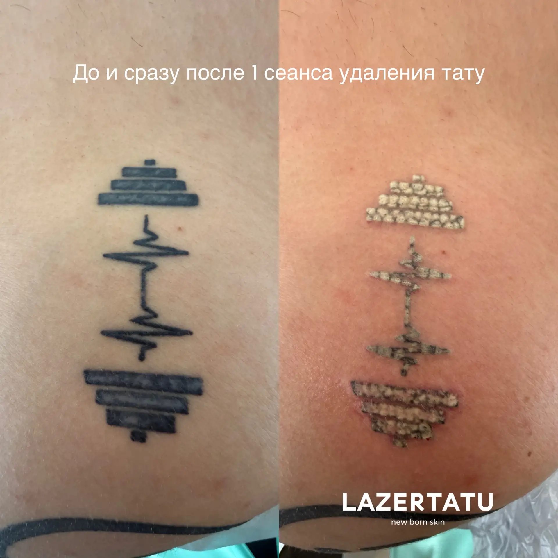 НОВОСТЬ 🔥 ПИКО ЛАЗЕР у нас в студии 👍🏻👍🏻👍🏻 Первые результаты, для сравнения, посмотрите видео