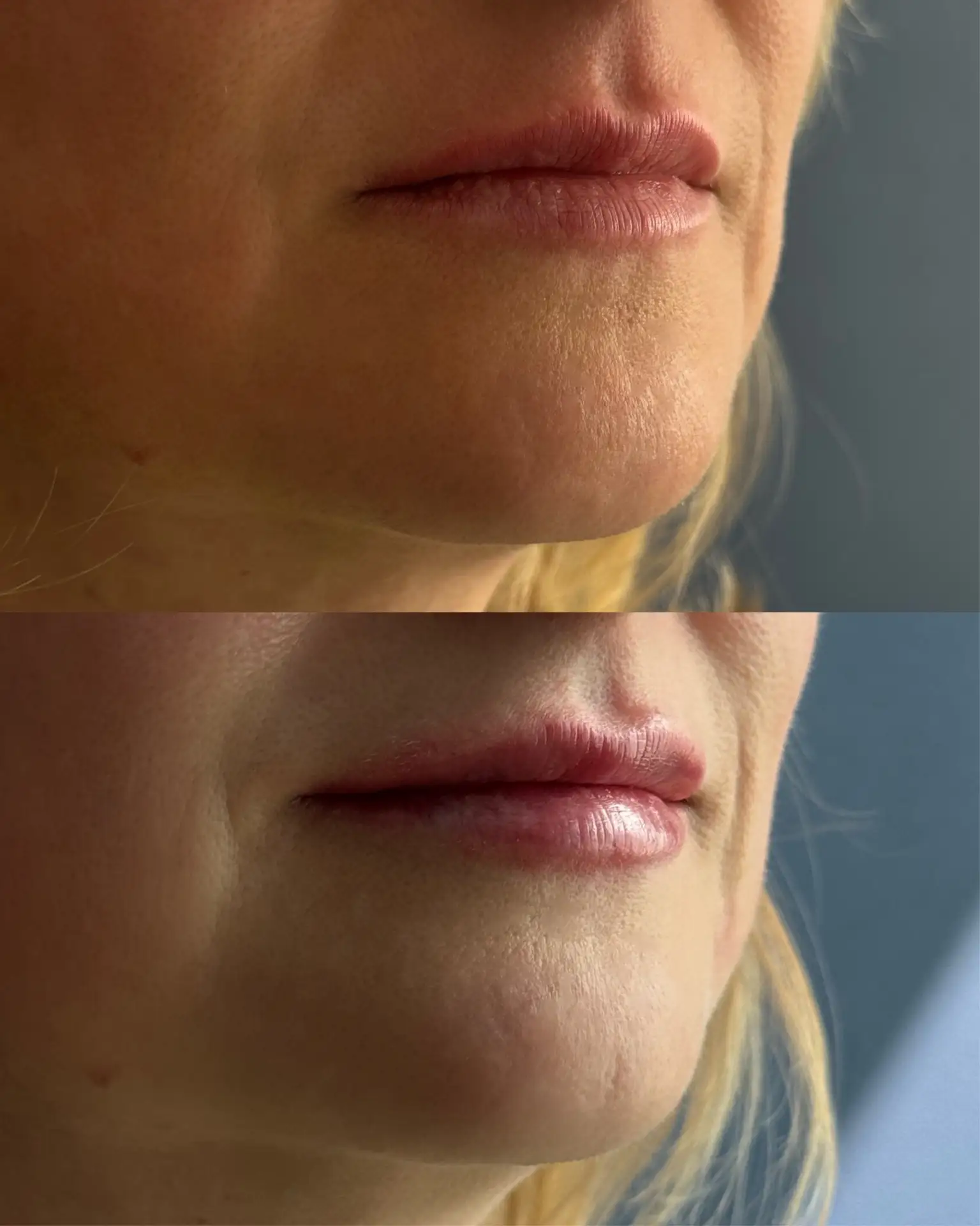 Контурная пластика губ препаратом Belotero Lips Shape

Изначально — чёткие, графичные губы.
Основной