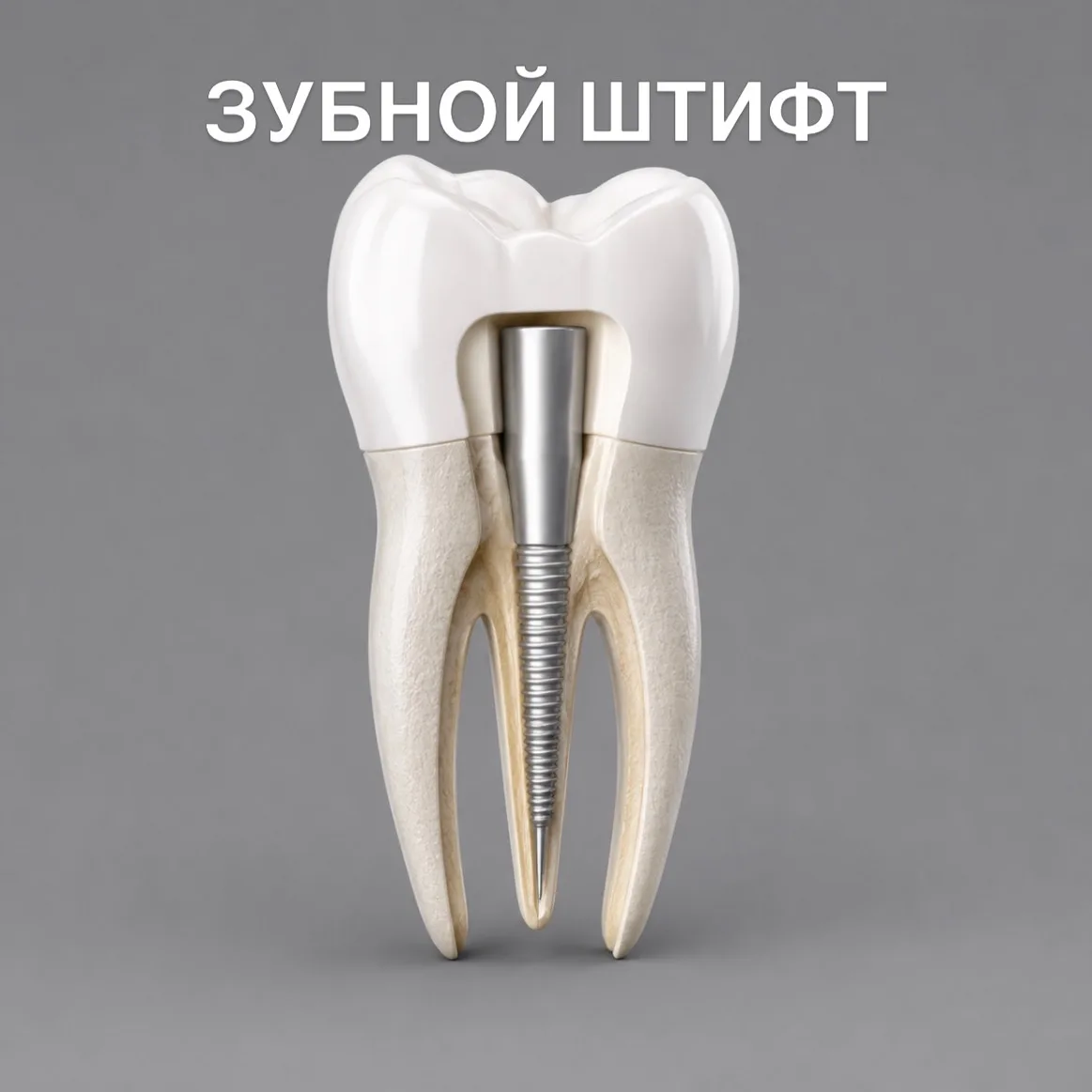 🦷 Что такое зубной штифт и зачем он нужен?

Когда зуб сильно разрушен, обычной пломбы может быть не