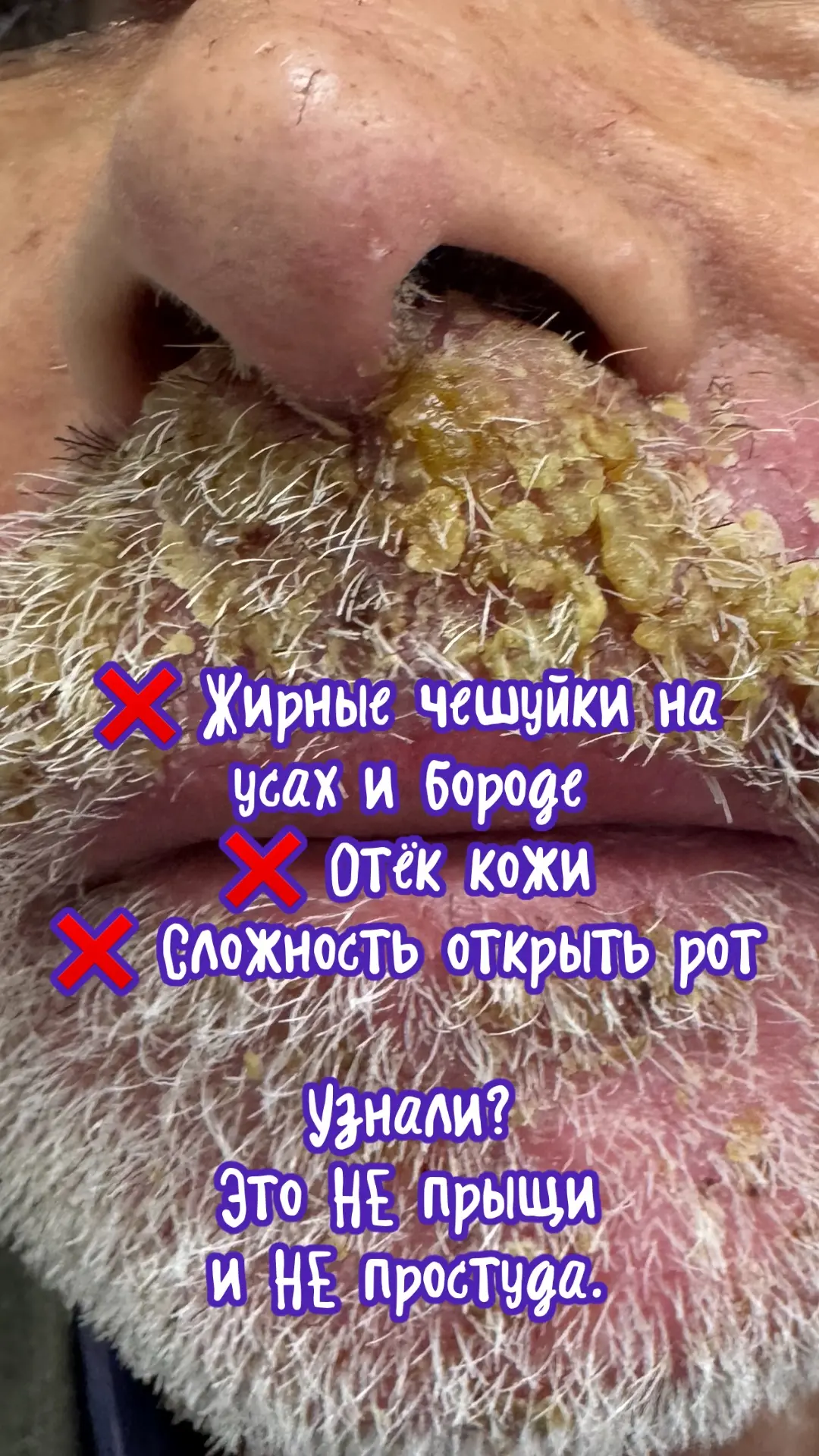 «Странный зверь» на бороде: когда бритье становится пыткой

Друзья, знакомо?

👉 На усах и бороде — 