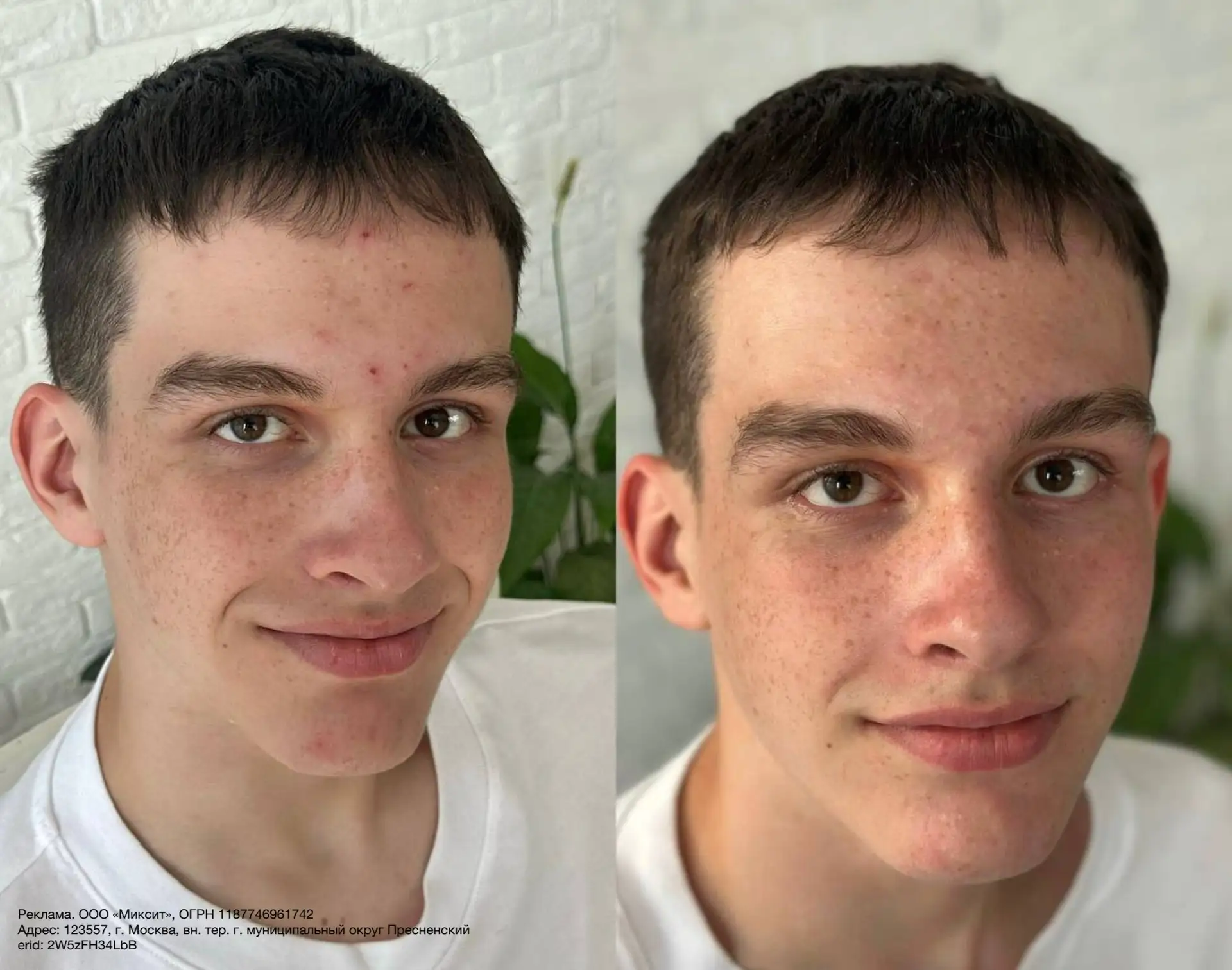 Посвящается всем мамам подростков 🤍

Эту сыворотку Stop Acne от Mixit я покупала сыну-подростку  — 
