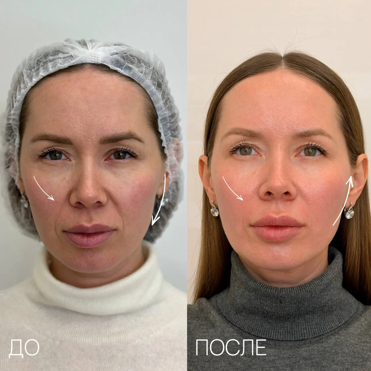 Меньше морщин – больше лифтинга ✨

Хотите лифтинг лица и естественное омоложение без инъекций? Тепер