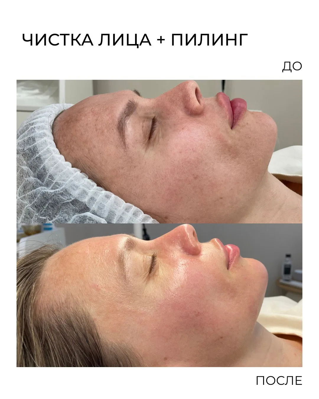 Показываю, как кожа может измениться всего за одну процедуру ✨

Комбинированная чистка + мягкий пили