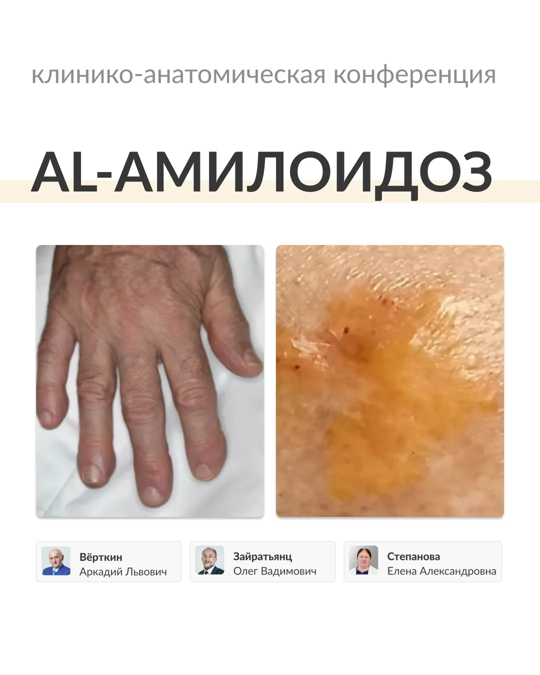 AL-амилоидоз остается одной из наиболее сложных для своевременного распознавания патологий в амбулат