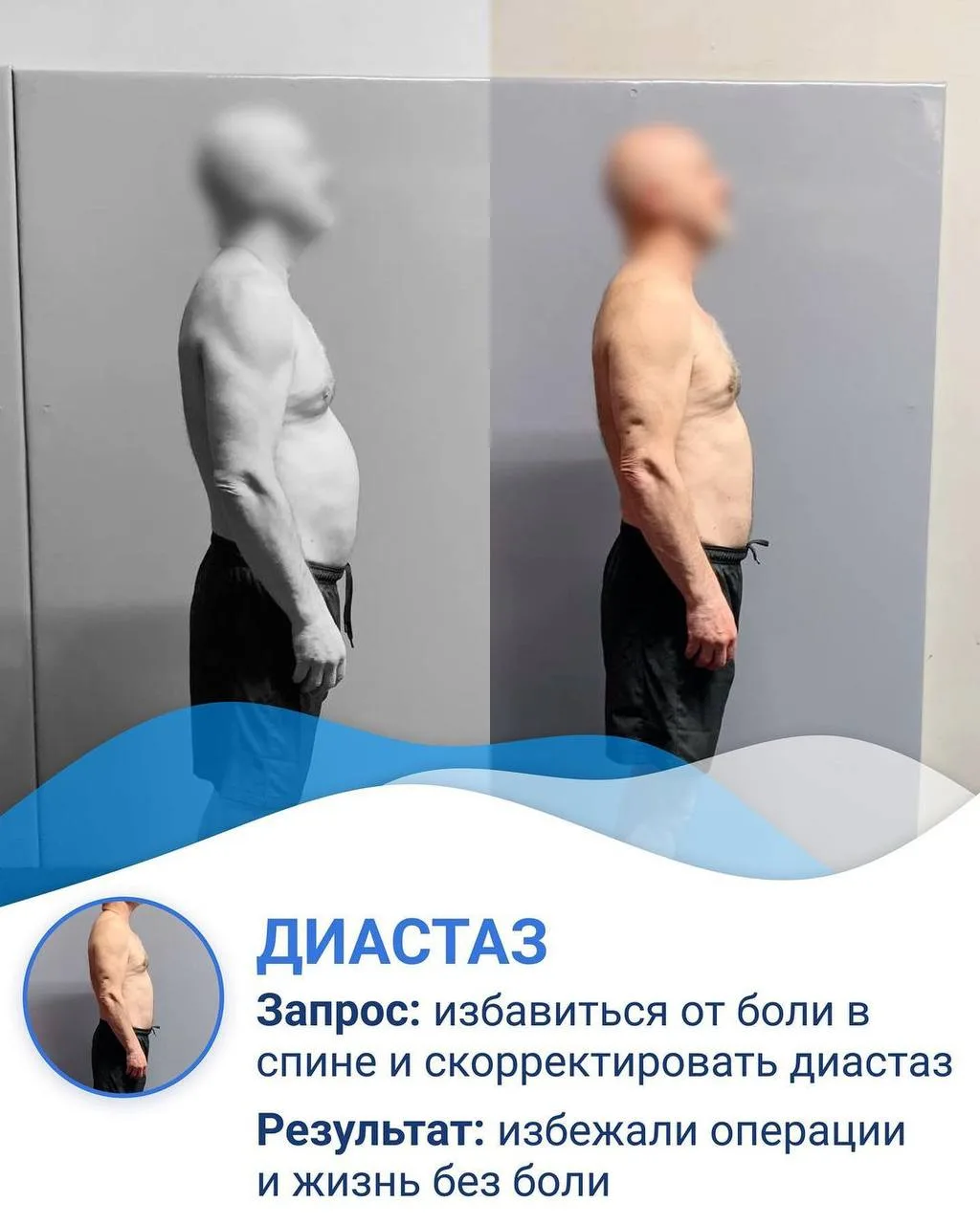 ВЫВАЛИВАЮЩИЙСЯ ЖИВОТ У МУЖЧИН И АЛКОГОЛЬ НЕ ВСЕГДА ВЗАИМОСВЯЗАНЫ

Причиной может стать диастаз!

С К