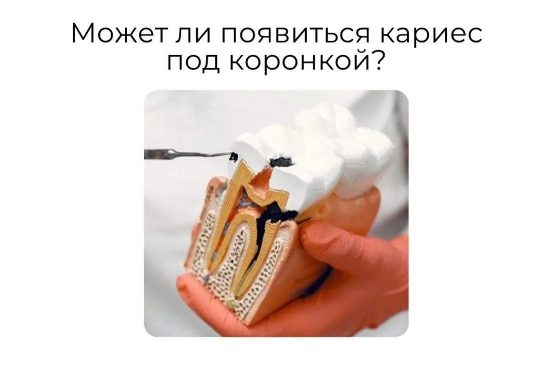 Может ли появиться кариес под коронкой?
Да! И заметить это на раннем этапе пациенту самостоятельно б