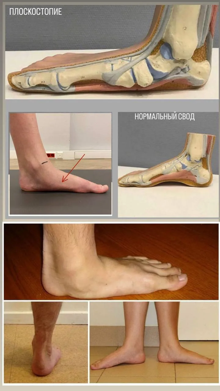 Нужно ли лечить плоскостопие? 🦶🏻
Плоскостопие (Pes planus) — это состояние, при котором снижается 