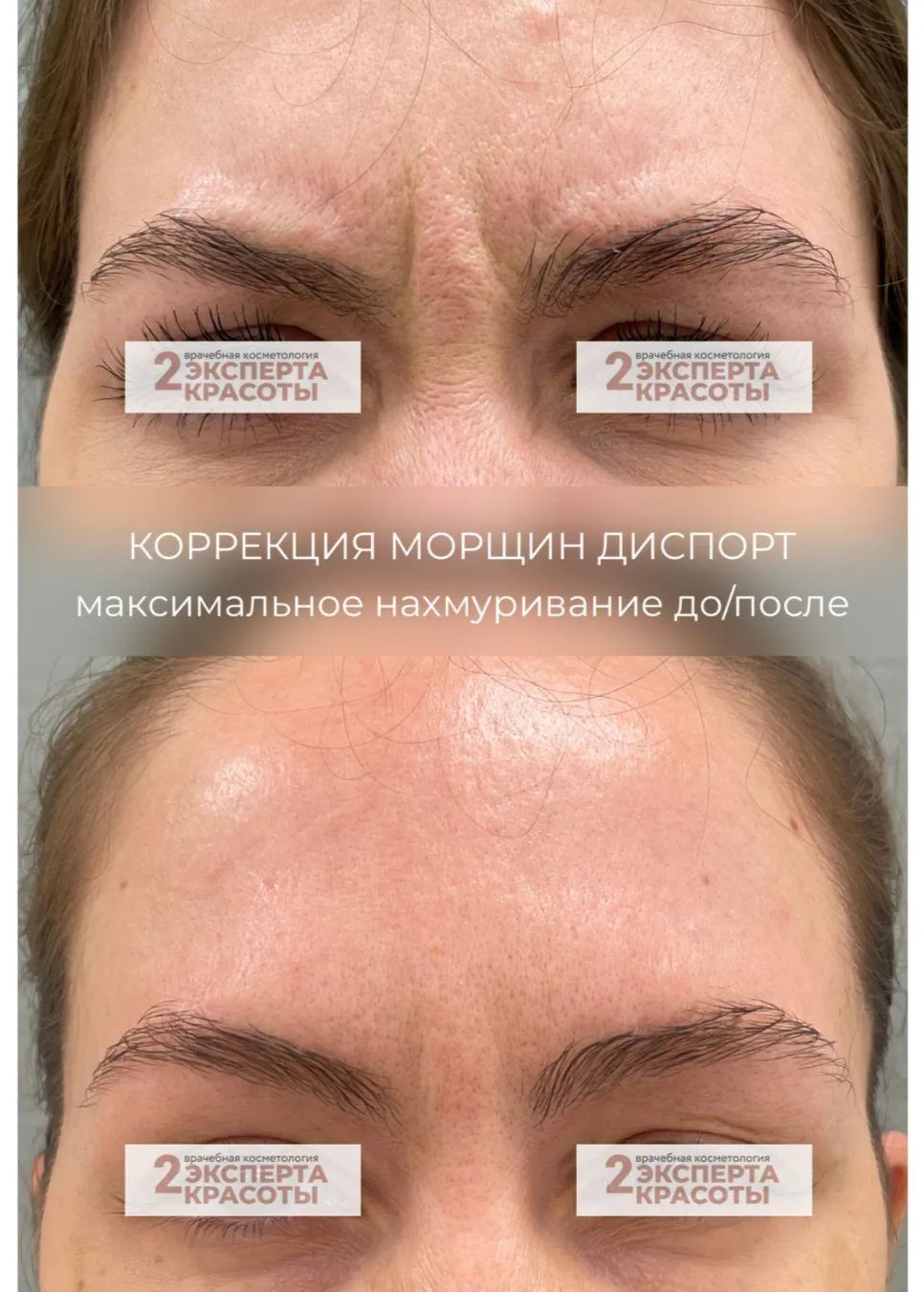 Идеальная гладкость за 1 визит 🔥Ботулотоксин — мимика сохраняется, морщины исчезают. Результат чере