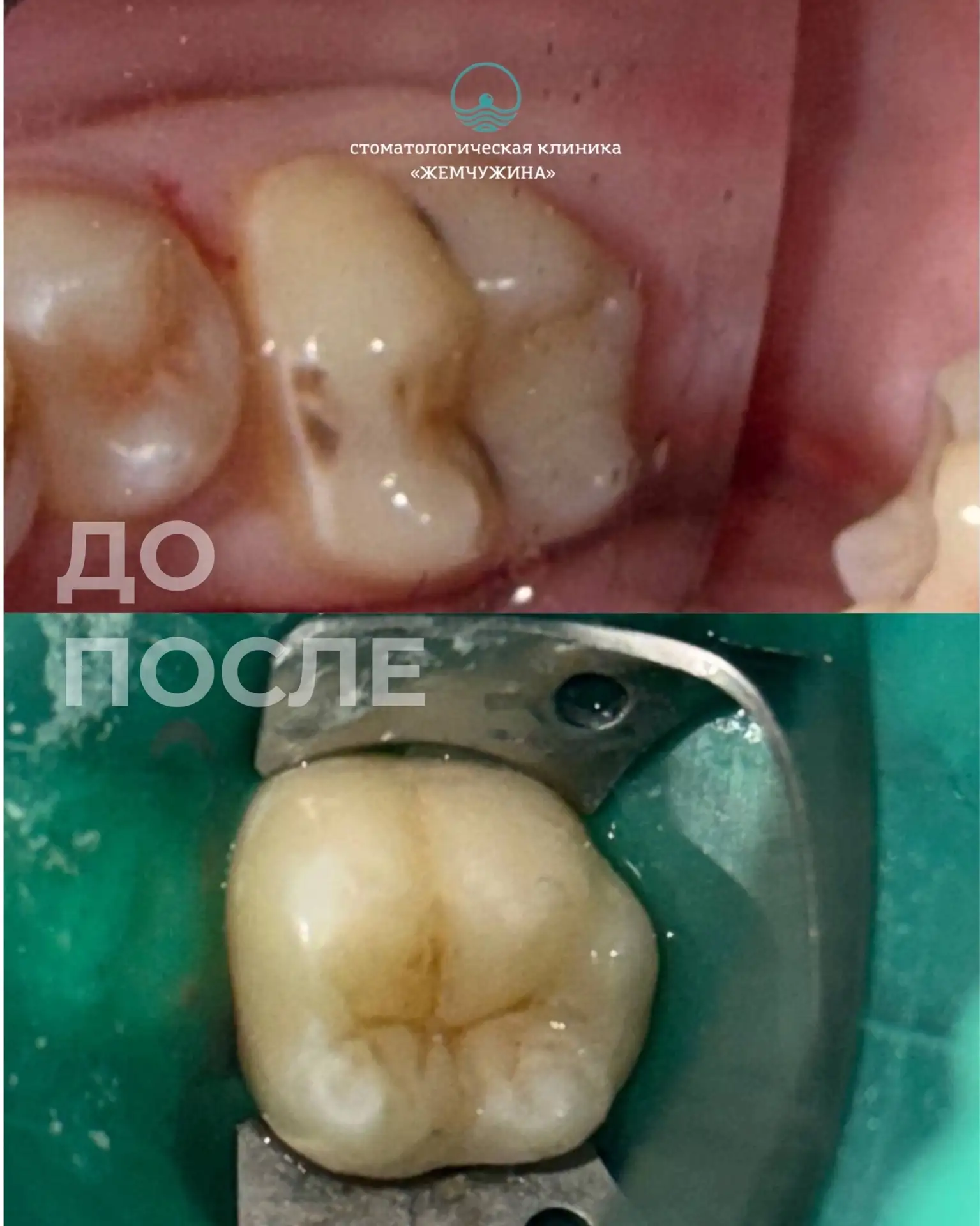 Немного красоты в ленту — и ещё один интересный кейс от нашего врача Анжелы Вячеславовны Стрелковой 