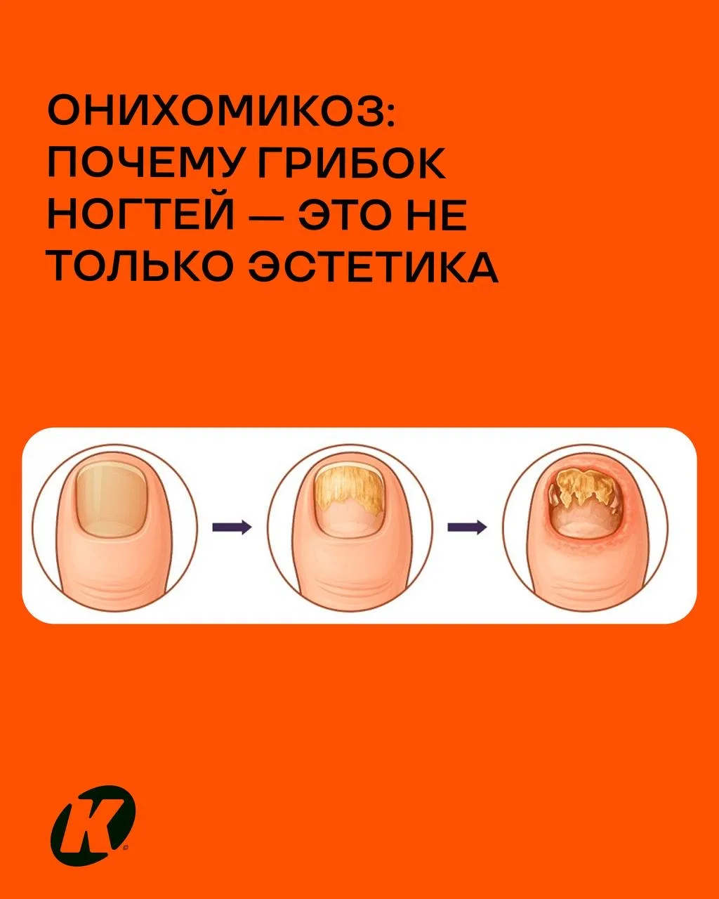 Онихомикоз: почему грибок ногтей — это не только эстетика

Онихомикоз — одно из самых распространённ