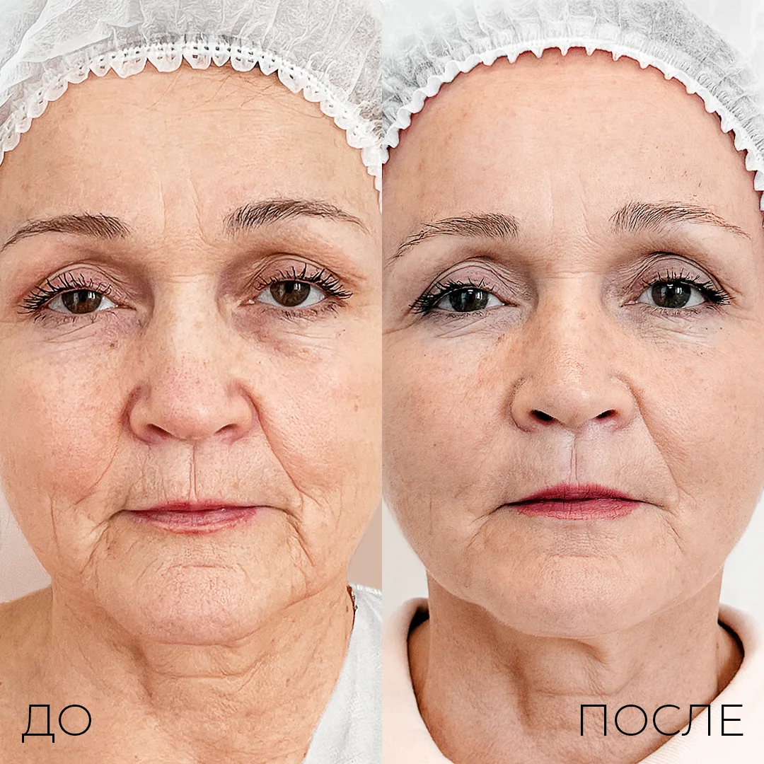 Комплексный подход, сочетающий поли-L-молочную кислоту Ellagen и нитевой лифтинг Aptos, становится с