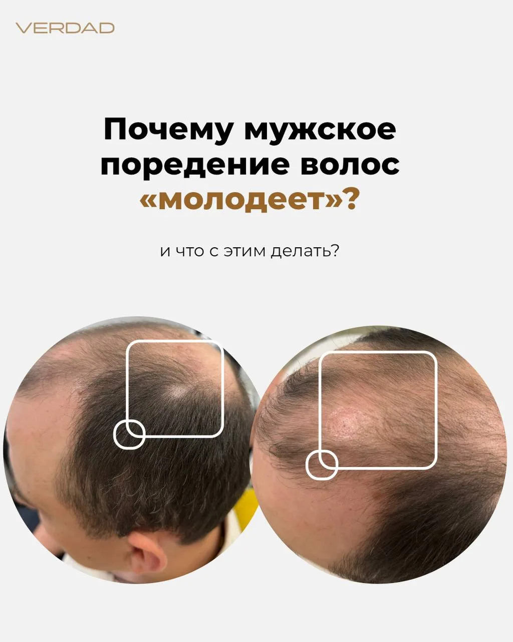 ПОЧЕМУ МУЖСКОЕ ПОРЕДЕНИЕ ВОЛОС «МОЛОДЕЕТ?»

Казалось бы, выпадение и поредение волос у мужчин должно