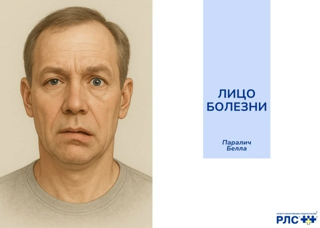 Продолжаем нашу рубрику «Лицо болезни»!

Паралич Белла – идиопатическая, самая распространенная форм