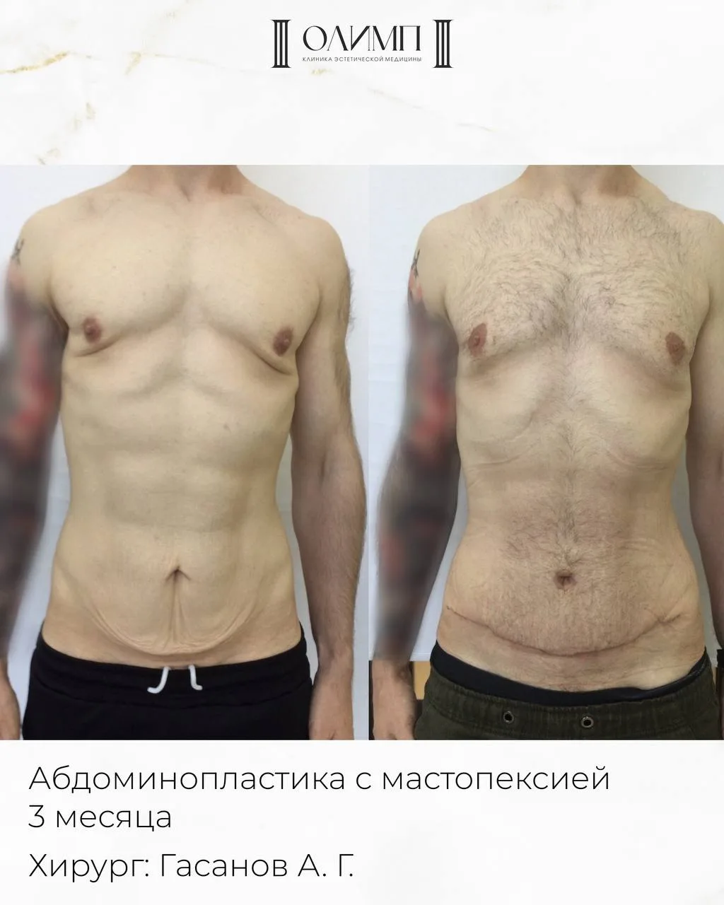 Была выполнена абдоминопластика с мастопексией.
Результат спустя 3 месяца после операции.
Хирург: Га
