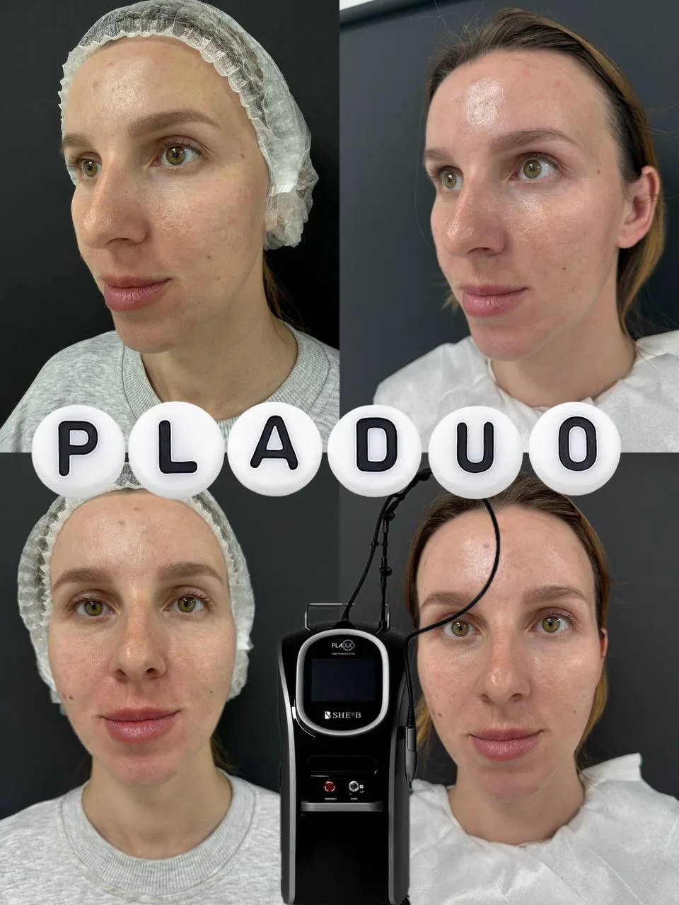 Для лечения акне на аппарате PLADUO используется аргоновая плазма

▫️ Аргоновая плазма обеспечивает 