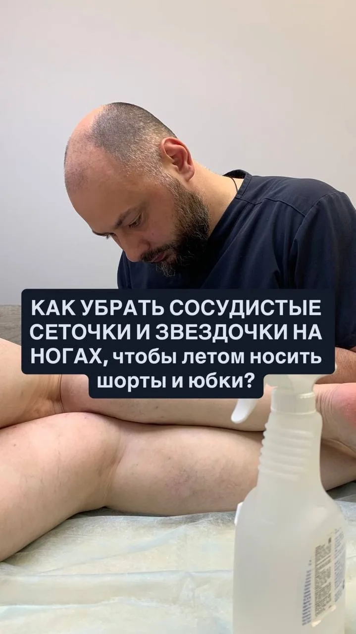 Нежелательные сеточки и звездочки на ногах можно убрать 2-мя способами. 
Это склеротерапией и процед
