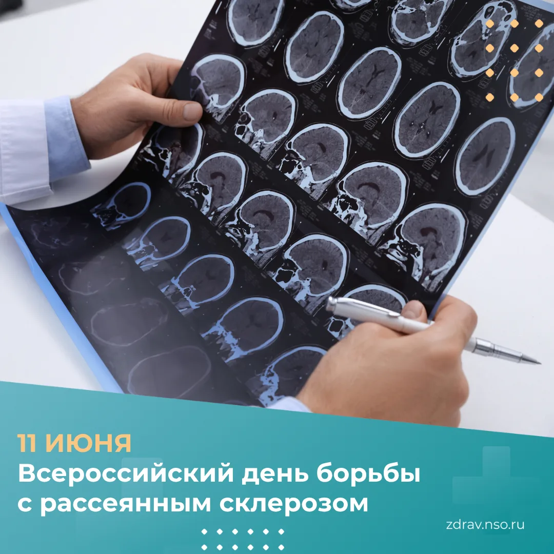 🗓 11 июня — Всероссийский день борьбы с рассеянным склерозом
Рассеянный склероз (РС) часто называют