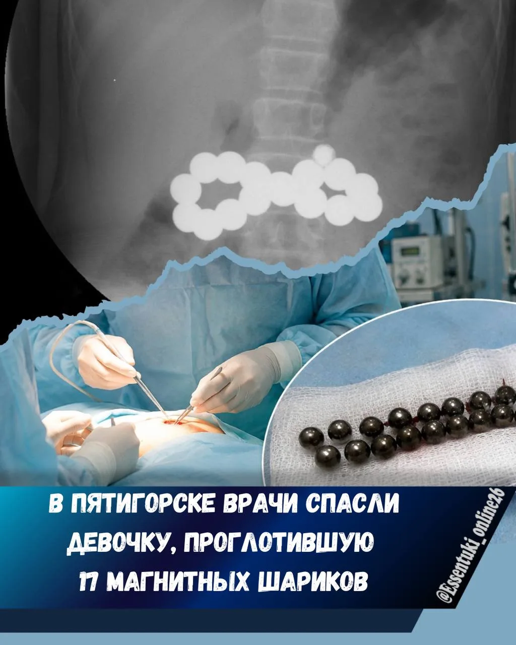 🩻👧 В Пятигорске прооперировали ребёнка, проглотившего магнитные шарики

Врачи извлекли из живота д