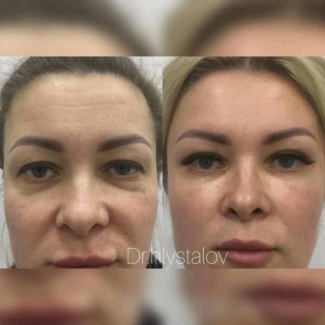 🌀На фото наша прекрасная пациентка, которой были выполнены:
1️⃣ блефаропластика верхних век и жирос