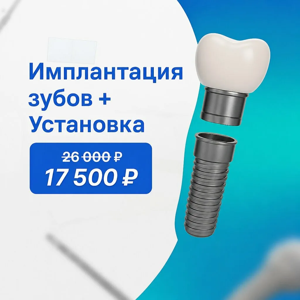 Имплантация зубов в Уфе за 17.500 руб! До конца месяца!

Отсутствие даже одного зуба — это не только