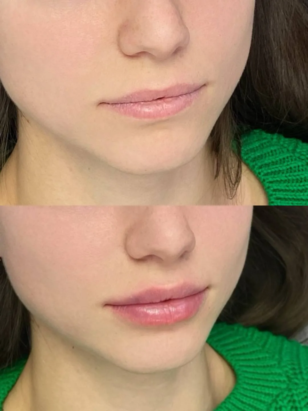 Натуральное увеличение губ в IB CLINIC😍

▫️Объем: 1 мл
▫️Время работы: 15 минут с анестезией
⠀
Запи