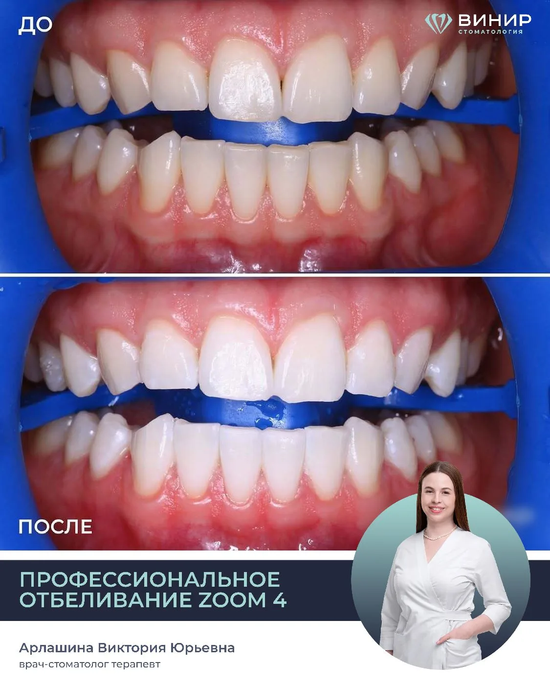 💎КЛИНИЧЕСКИЙ СЛУЧАЙ💎

Яркая, сияющая улыбка все лето! 

С помощью системы для профессионального от