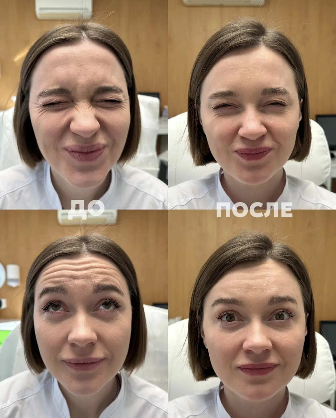 Коррекция мимических морщин ботулотоксином Миотокс! 

На фото «до/после» — результат комплексного по