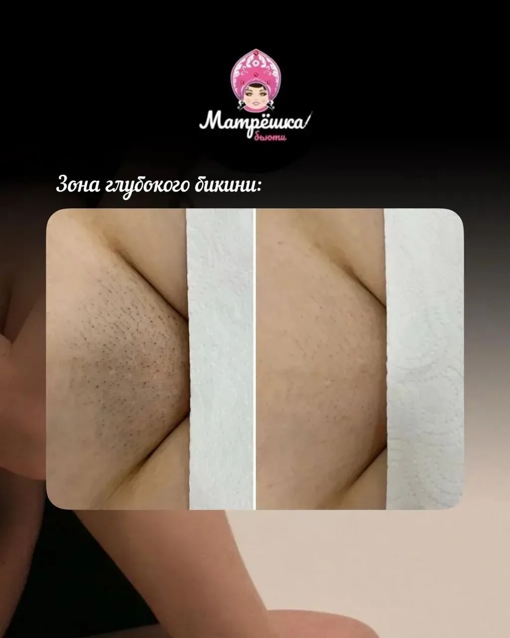 Вот такая красивая кожа после нашего лазера😍😍😍