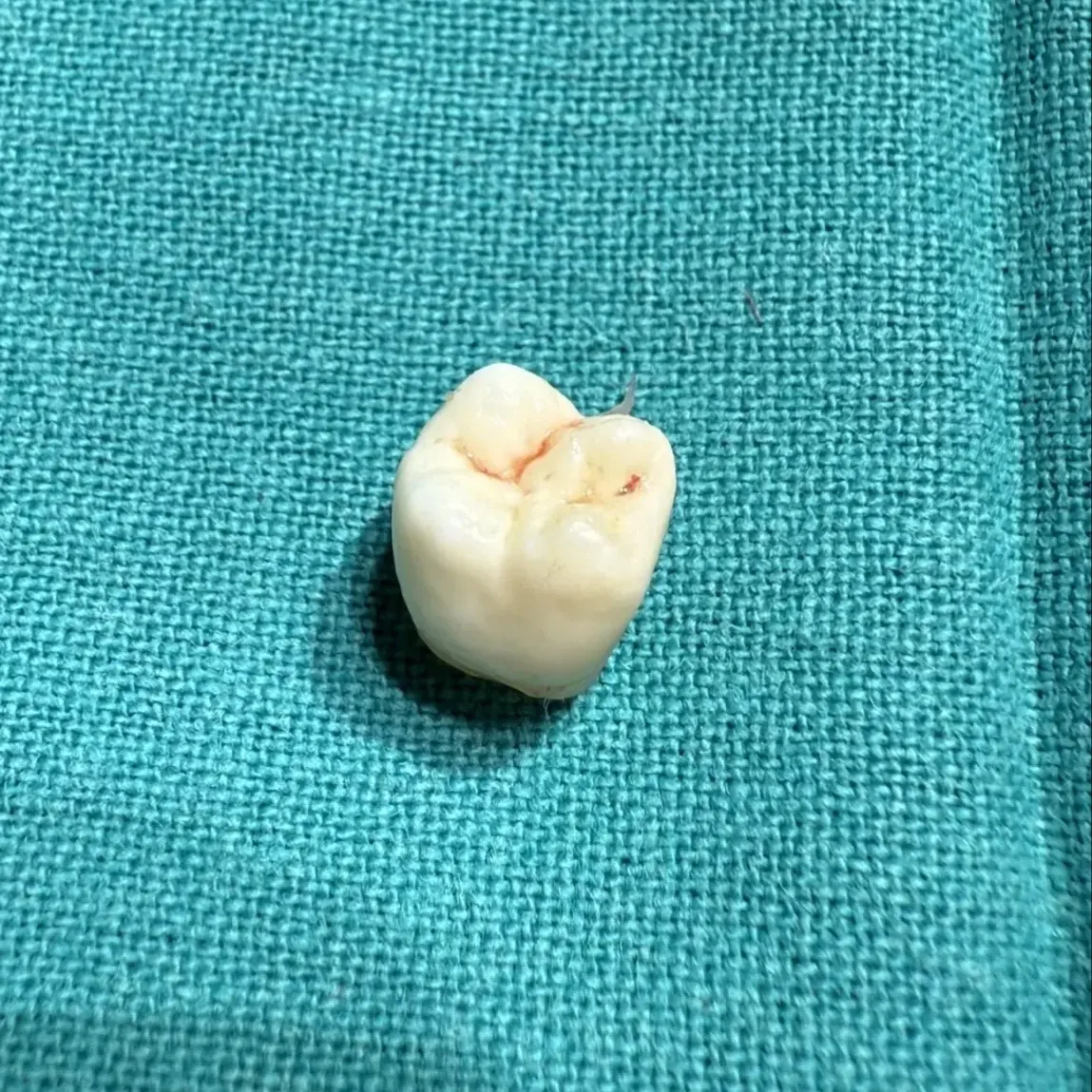 🦷 Зуб из яичника удалили акушеры-гинекологи РКБ. 

🏥 Доброкачественное образование в яичнике у 28-