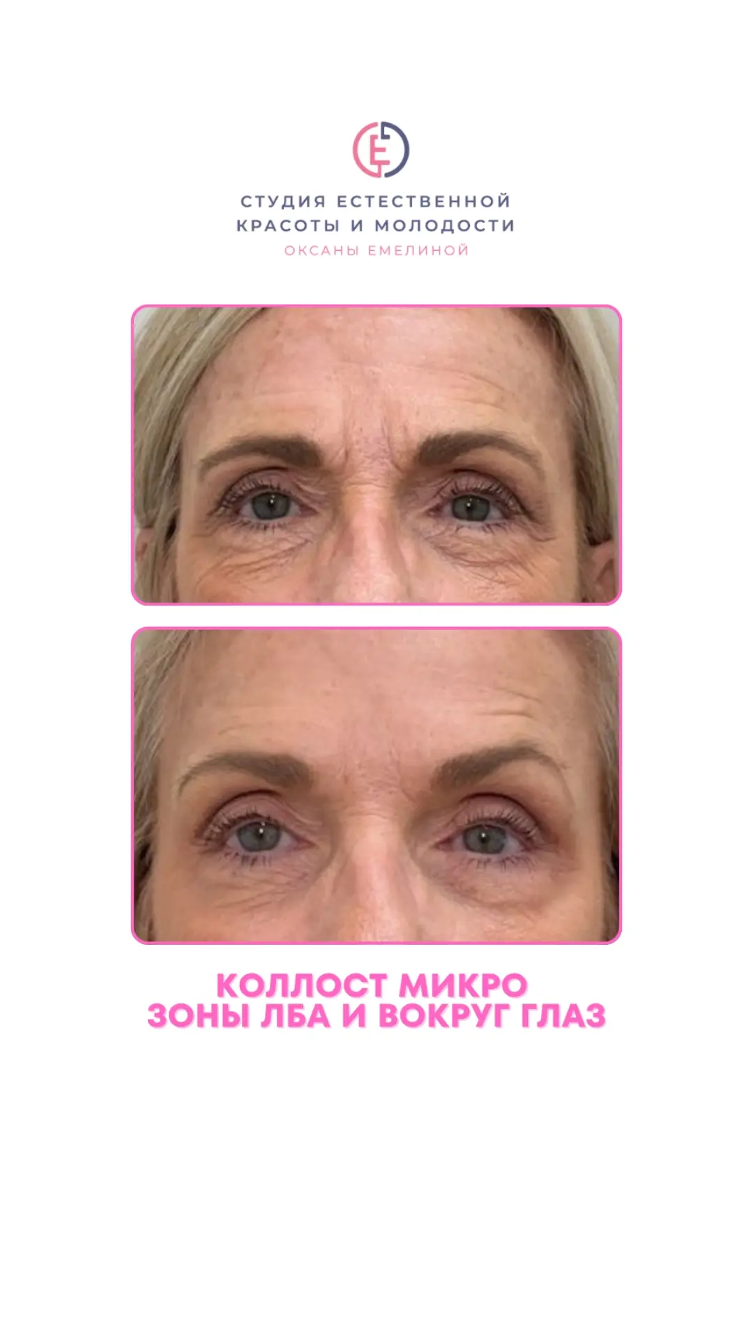 ПОЧЕМУ ТАК ВАЖЕН КОЛЛАГЕН ДЛЯ МОЛОДОСТИ КОЖИ❓

❗Коллаген - это главный структурный белок нашей кожи,