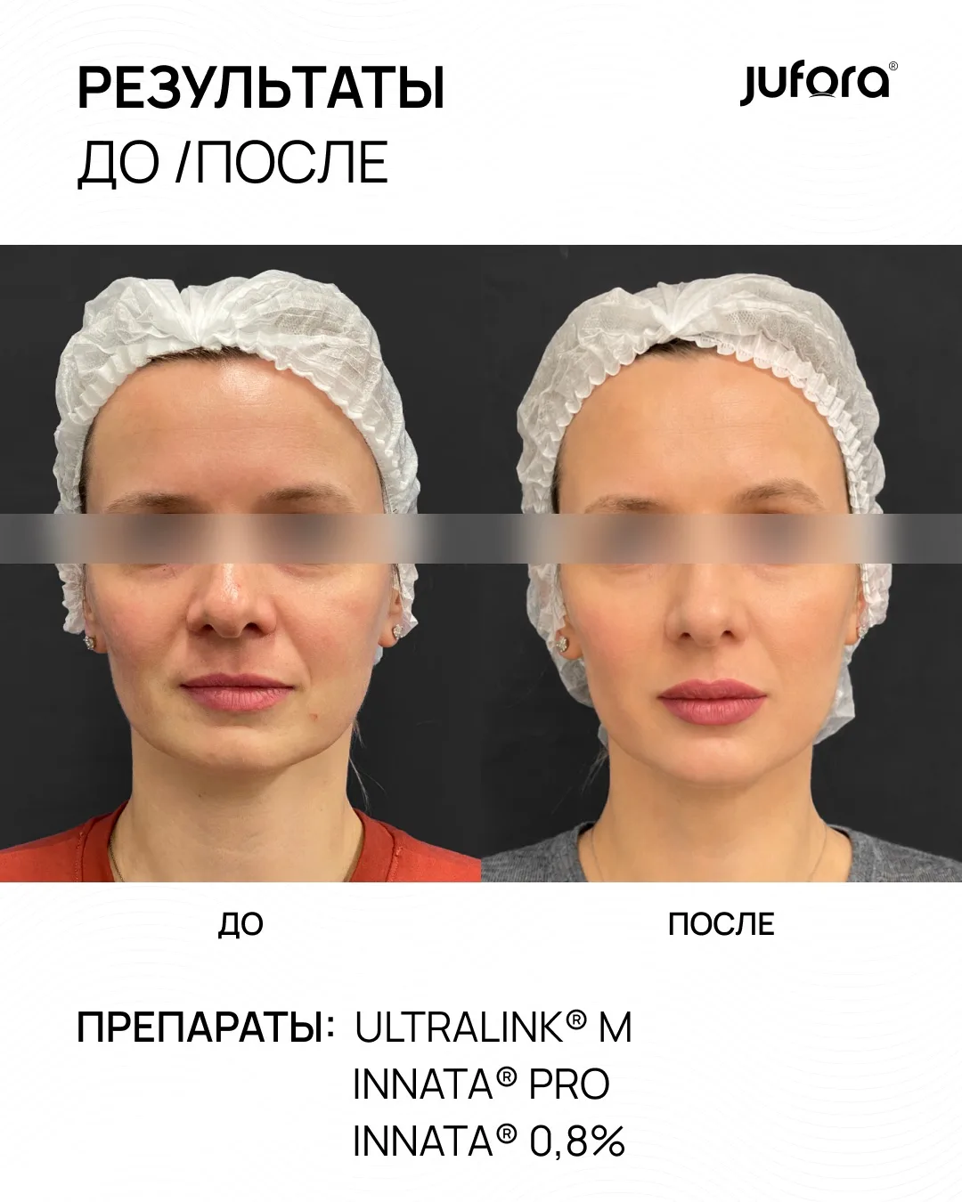 Говорим фактами, а не словами ❤️

Комплексный протокол JUFORA®:

❤️ INNATA 0,8% – деликатная коррекц