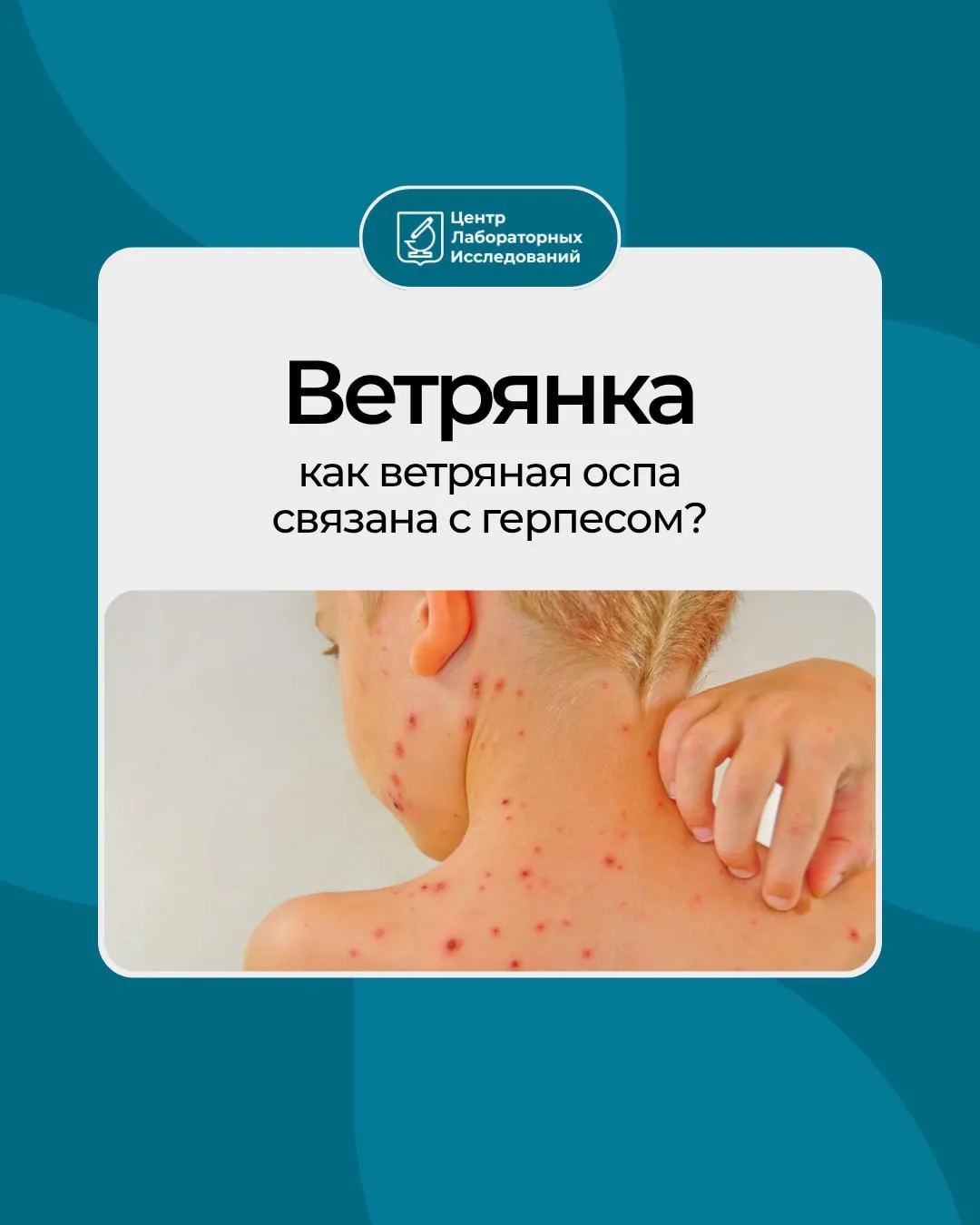 Продолжаем разговор о герпесе.
Знакомая с детства ветрянка — тоже относится к этому семейству. Вирус