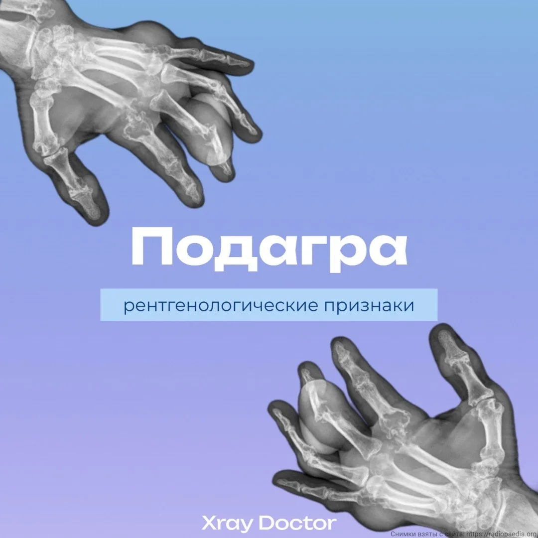 Типичные рентгенографические признаки подагры включают: 
- эрозии костей с выступающими краями и скл