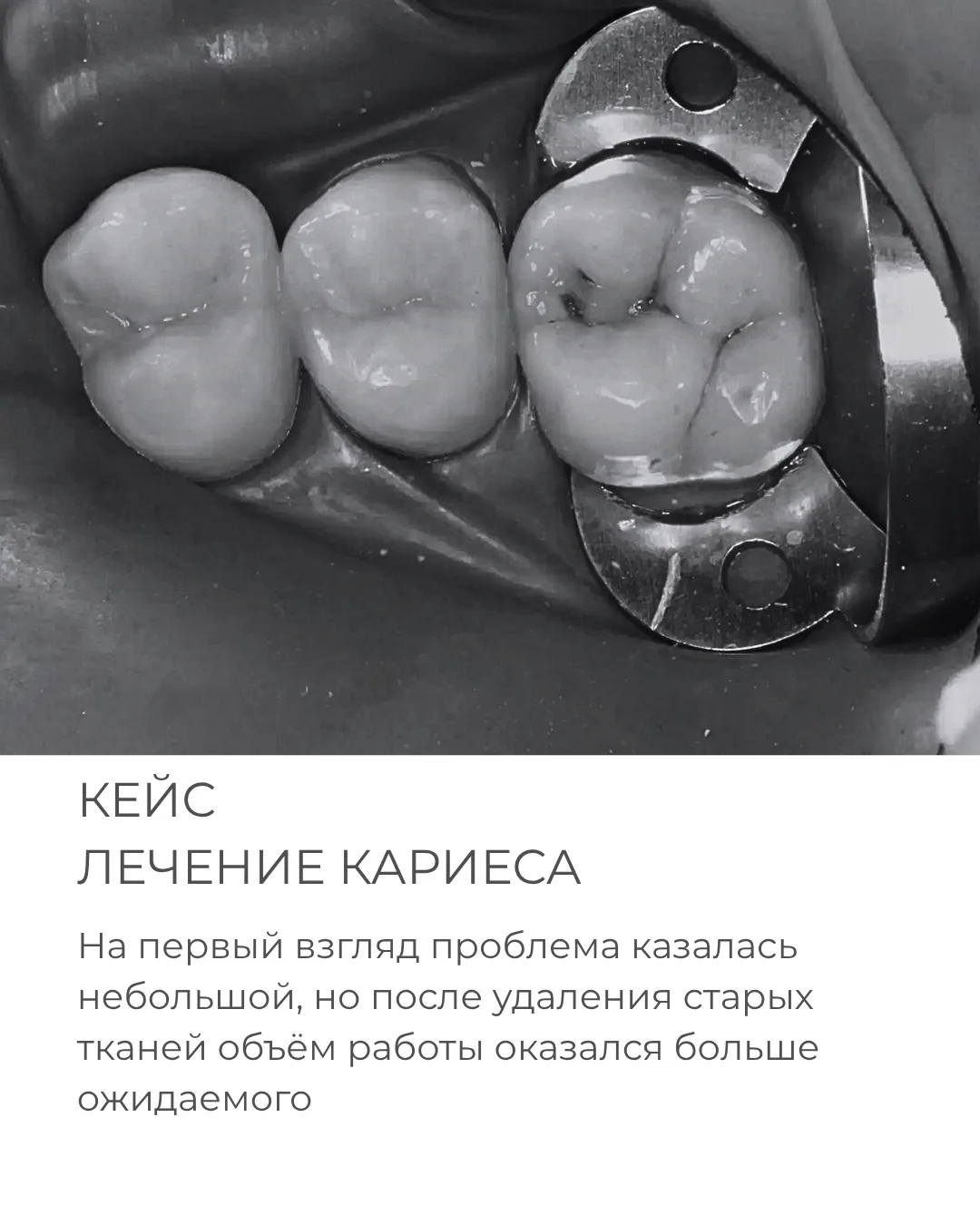 🦷«Да вроде не болит…» — одна из самых частых фраз, которые мы слышим на приёме.

Именно так началас