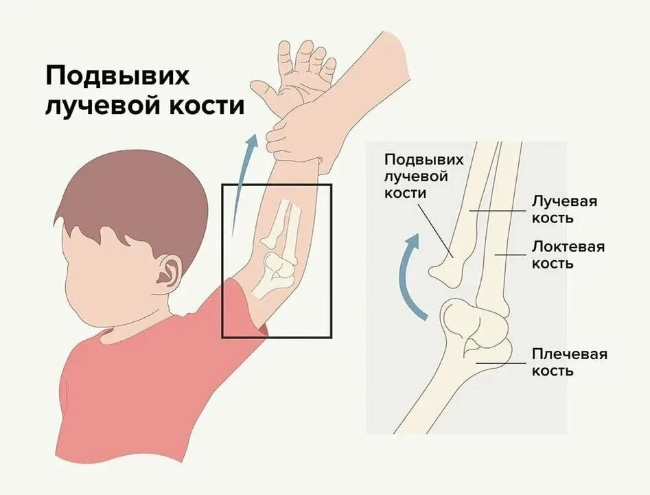 Осторожно, «нянькин локоть»! Почему нельзя поднимать детей за руки? 👶🚫

Кажется, что может быть пр