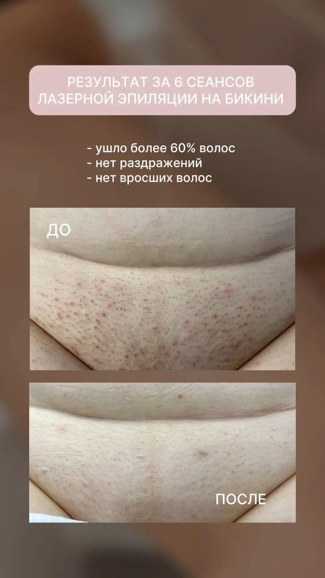 😔 Устали от вросших волос и раздражения после бритья? 

Посмотрите на результат всего после 6 проце