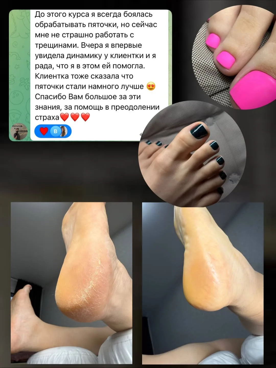 Для тех кто не знал, или просто забыл- хочу напомнить программу : 

✅Уникальная техника пилинг педик