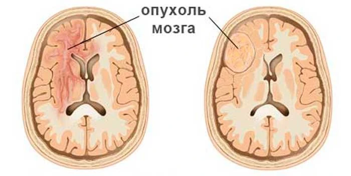 Опухоль головного мозга — это новообразование, которое развивается в тканях мозга, его оболочках, че