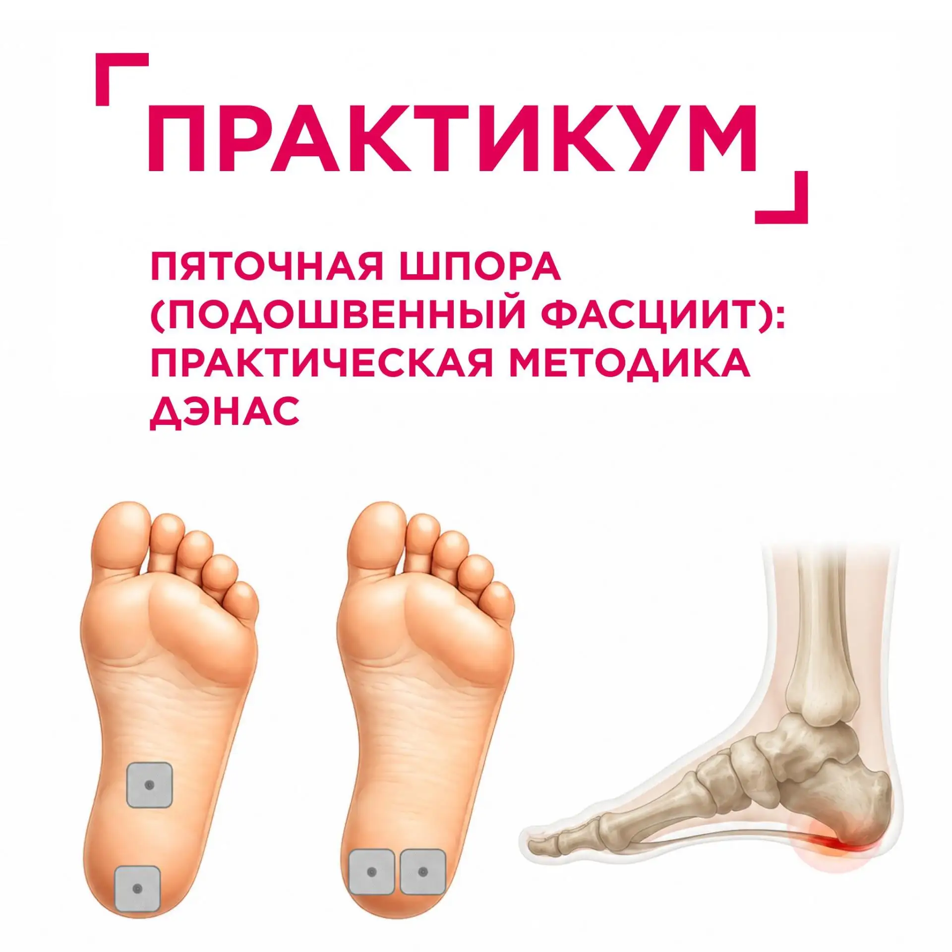 Рубрика: Практикум🦶 Пяточная шпора (подошвенный фасциит): практическая методика ДЭНАС

Каждый шаг в