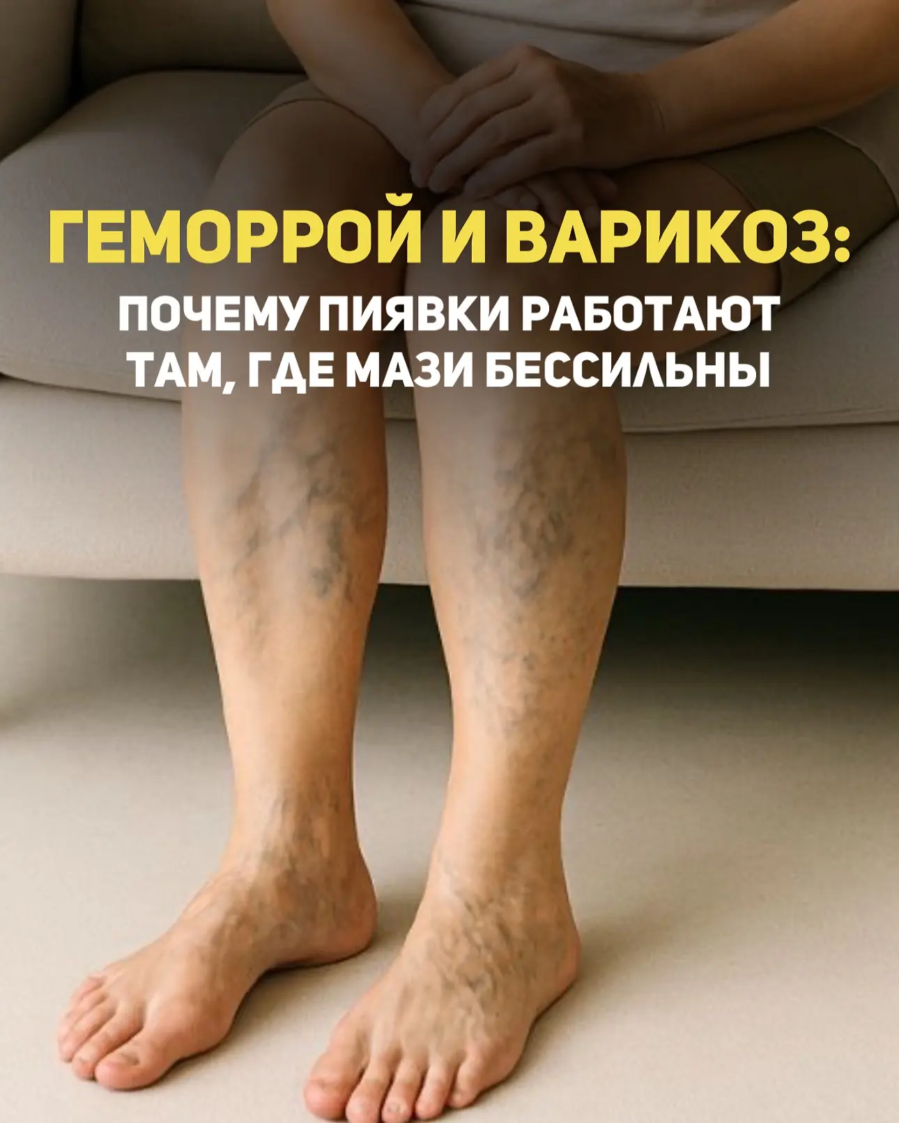 🔹 Геморрой и варикоз: почему пиявки работают там, где мази бессильны

Геморрой и варикоз — две проб