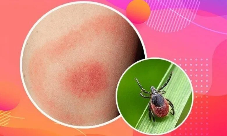 Мигрирующая эритема: главный симптом, который нельзя игнорировать

Каждый год с началом весенне-летн