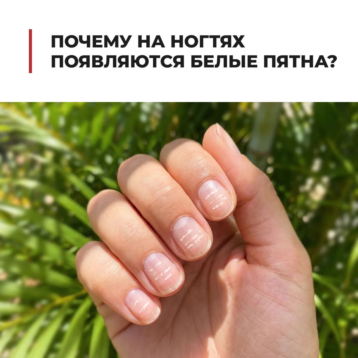 Наверняка вы хотя бы раз замечали на ногтях маленькие белые точки или полоски. Скорее всего, кто-то 