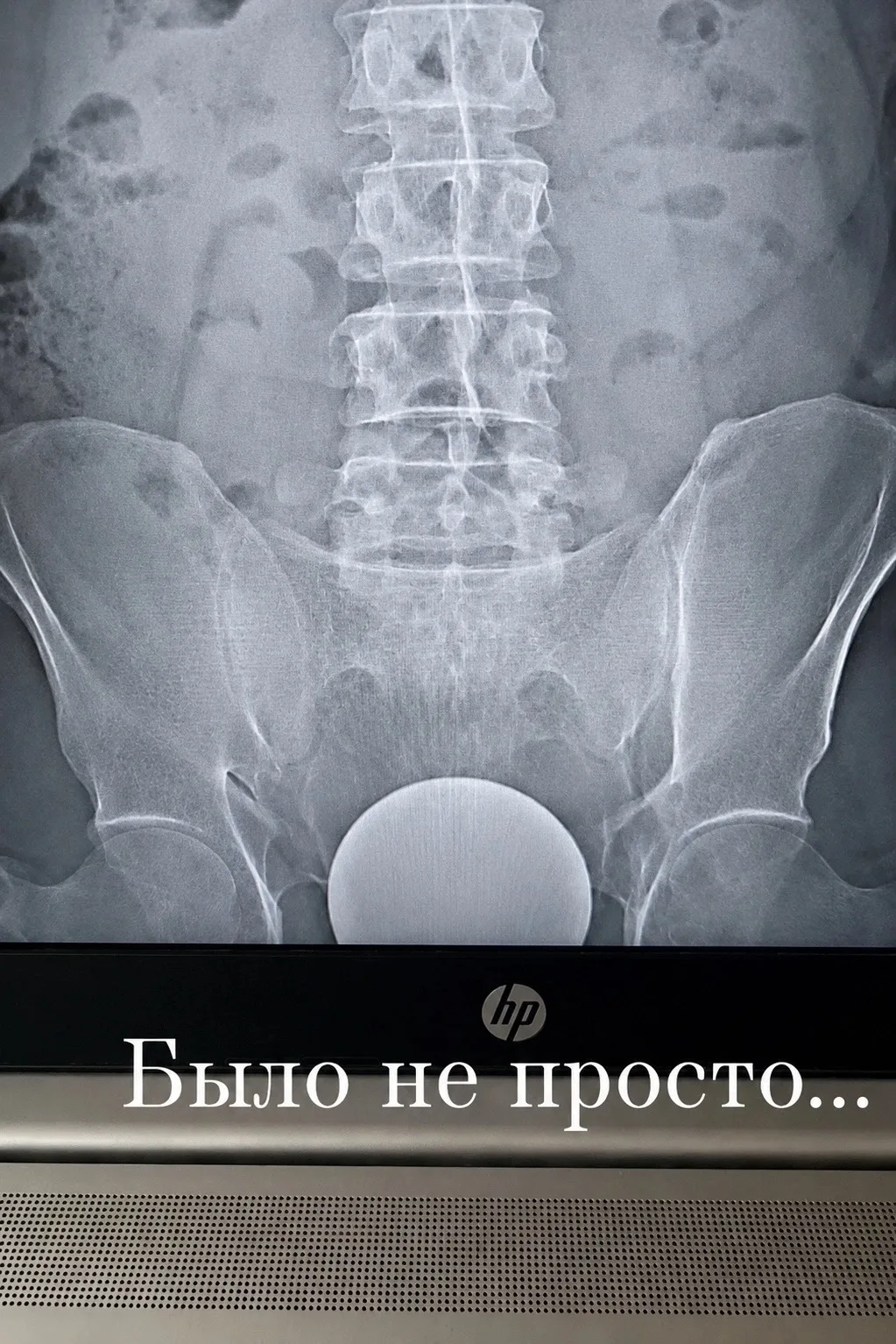 Парень попытался убедить врачей, что стеклянный шар диаметром 10😱 см телепортировался ему в задницу