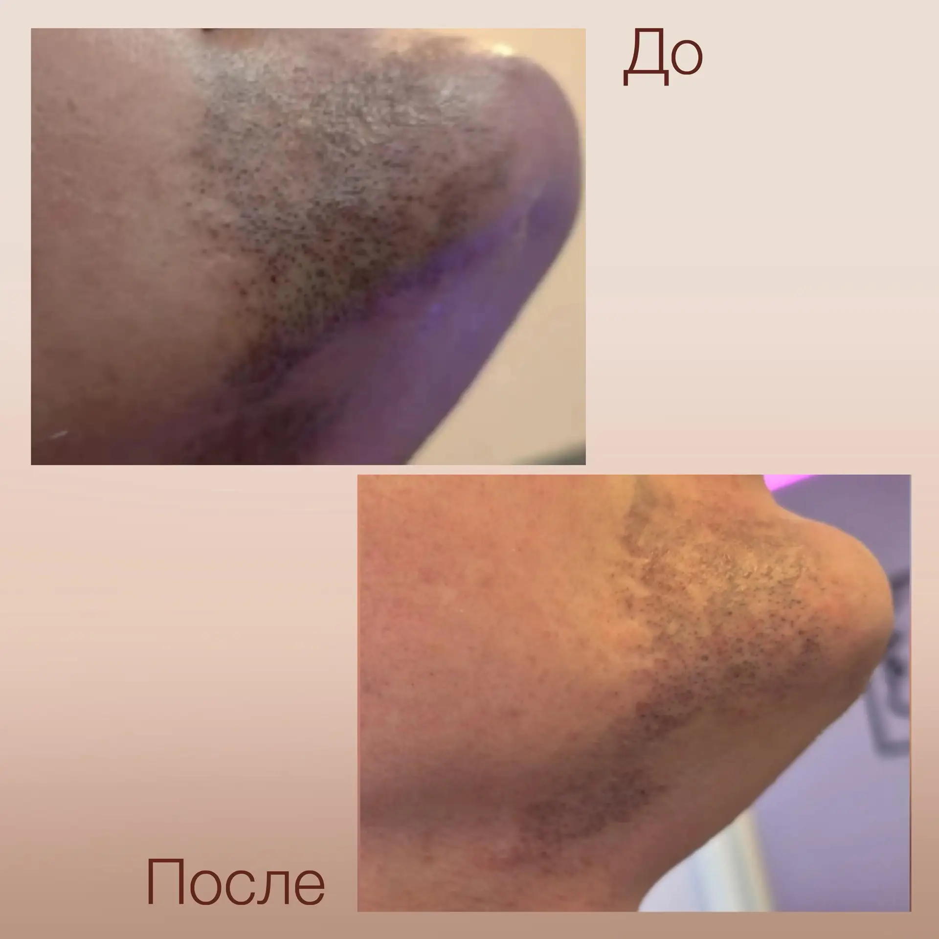 Когда и какой эффект ждать от лазера? 
⠀
Уже через две недели после 2-3 процедур можно заметить перв