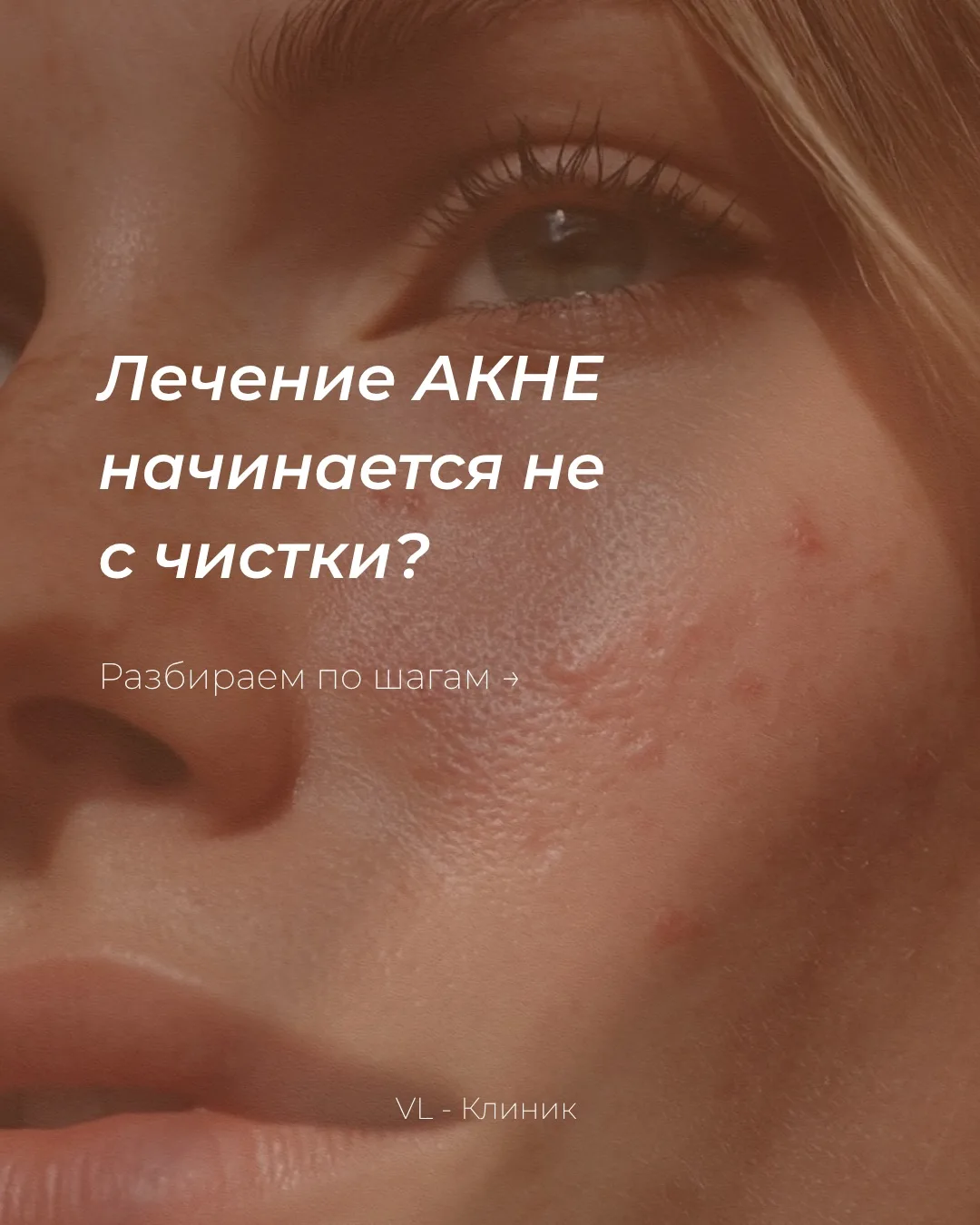 Акне — заболевание, которое требует системного подхода ✨

В карточках разобрали, с чего действительн